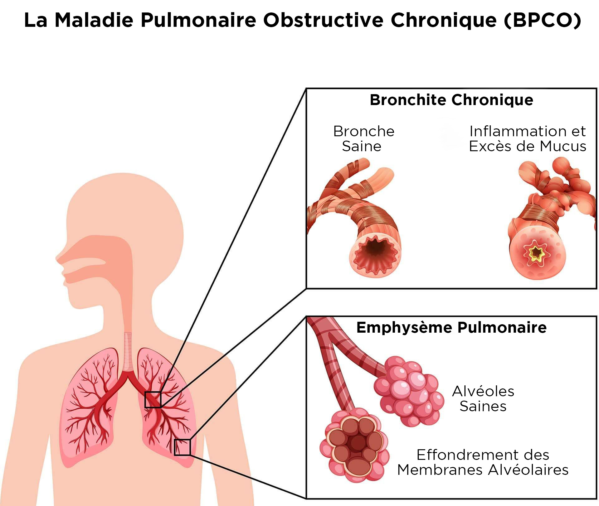 Alvéoles pulmonaires en BPCO et emphysème pulmonaire