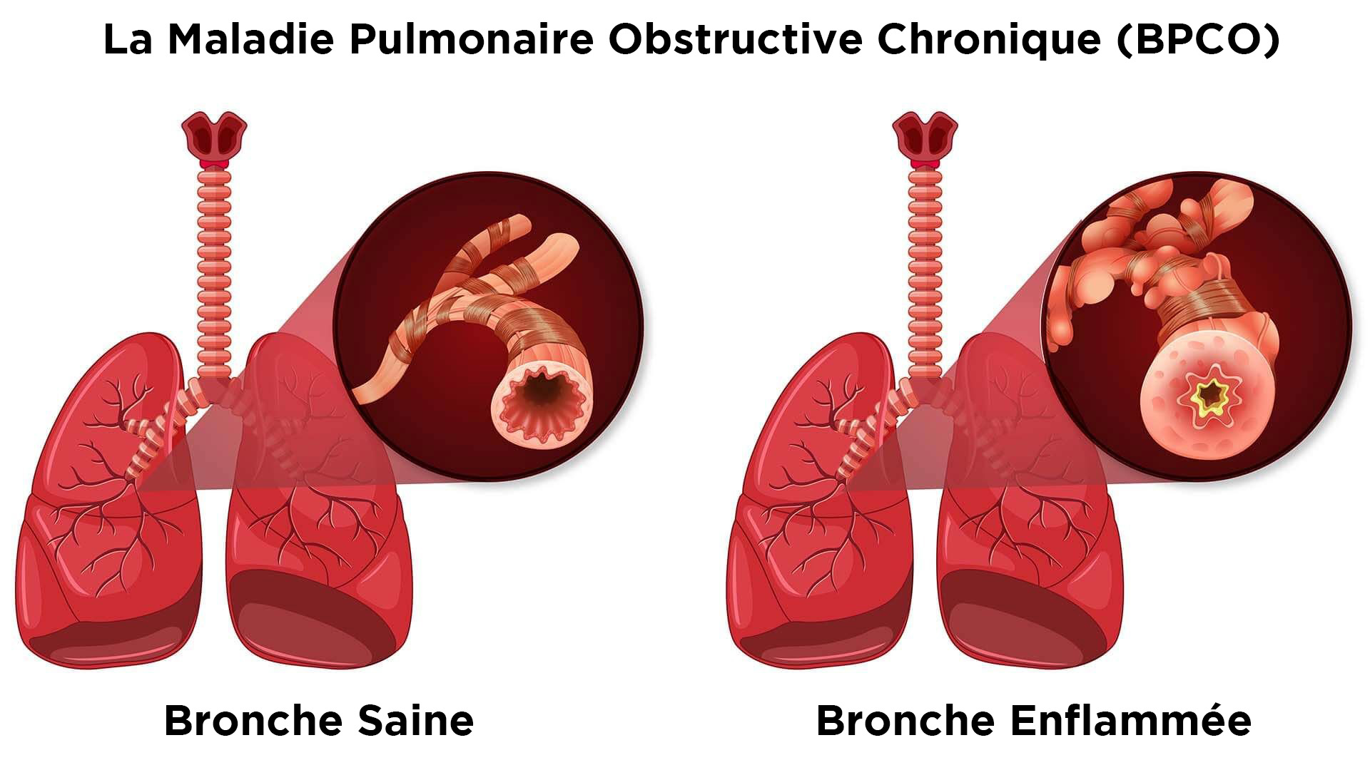 Bronche saine et bronche des patients BPCO