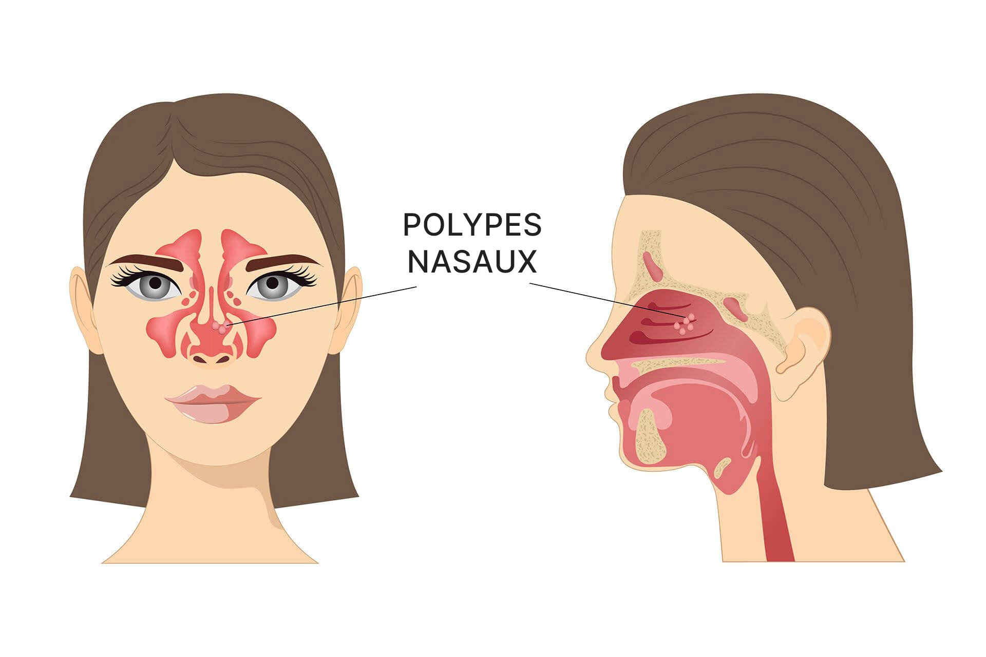 Polypes nasaux